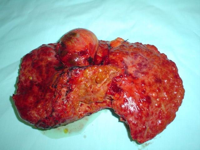 Cirrose do Fígado