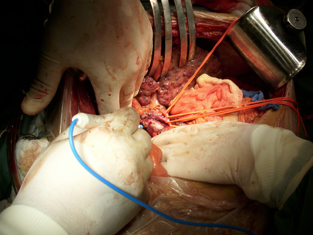 Cirurgia do Receptor de Transplante de Fígado