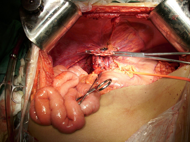 Cirurgia do Receptor de Transplante de Fígado
