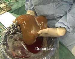 http://laparoscopicsurgeon.net.au/images/donor_liver.jpg