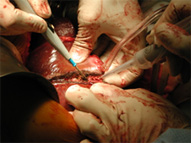 http://laparoscopicsurgeon.net.au/images/liver_resection.jpg
